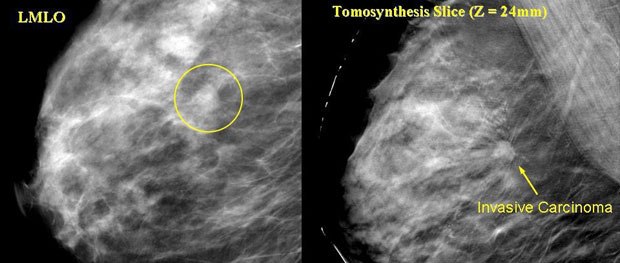 Technology has caught up with theory with mammograms. On the left is a standard 2D left medio-lateral oblique (LMLO) view with an obscure lesion while a tomosynthesis slice clearly shows a patent lesion. Courtesy of Mercury Computer Systems. 